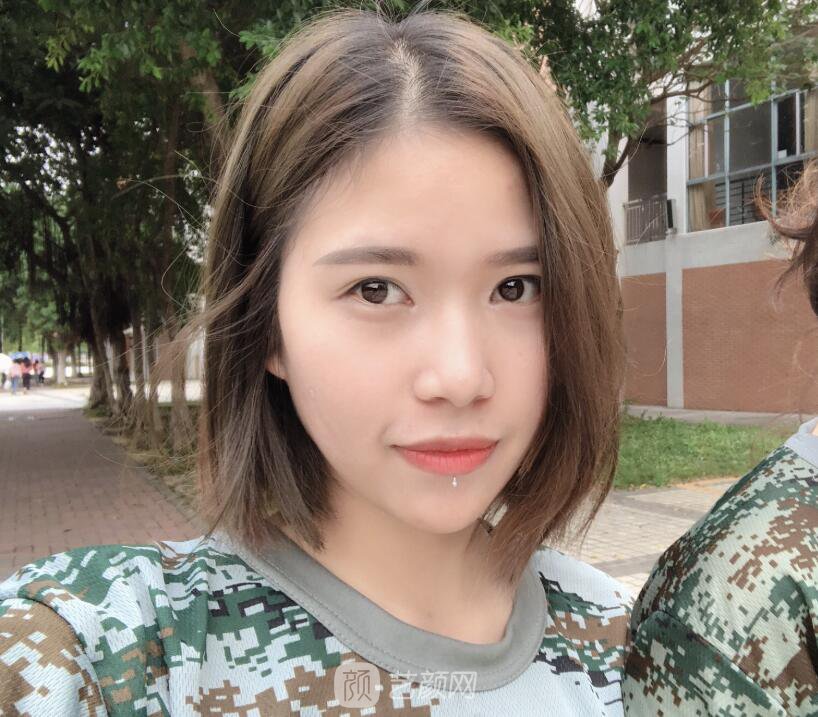 开眼角图真实案例分享哦