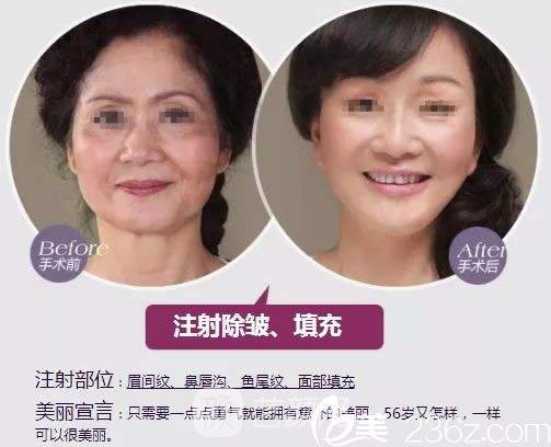 北京保妥-适除皱价格多少?