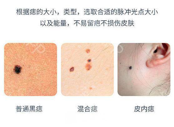 深圳激光去痣的价格是多少?