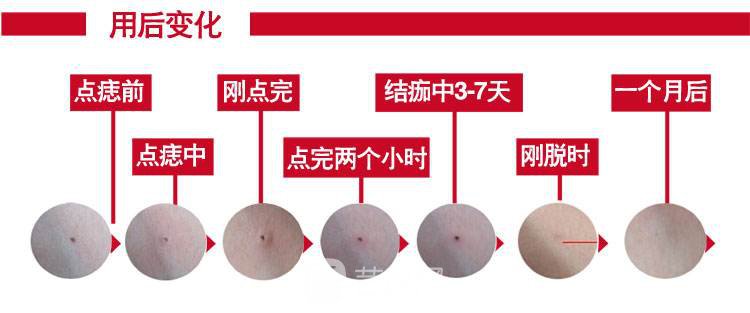 深圳激光去痣的价格是多少?