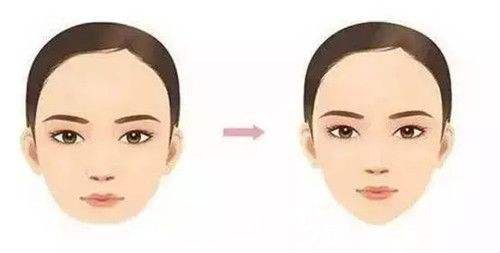 广州玻尿酸垫下巴价格?