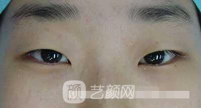 张娇娇医生做的小切口双眼皮手术案例