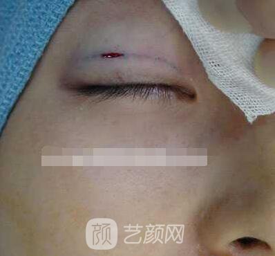 张娇娇医生做的小切口双眼皮手术案例