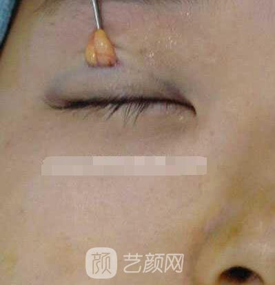张娇娇医生做的小切口双眼皮手术案例