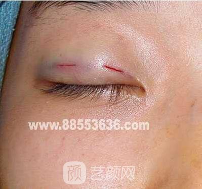 张娇娇医生做的小切口双眼皮手术案例