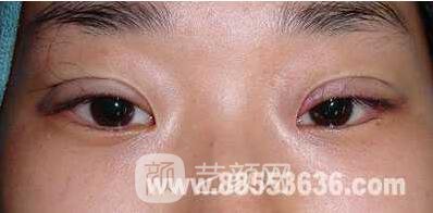 张娇娇医生做的小切口双眼皮手术案例