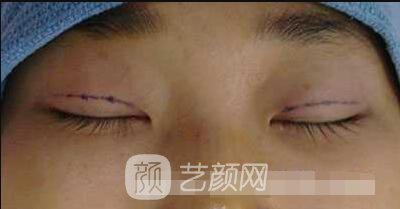 张娇娇医生做的小切口双眼皮手术案例
