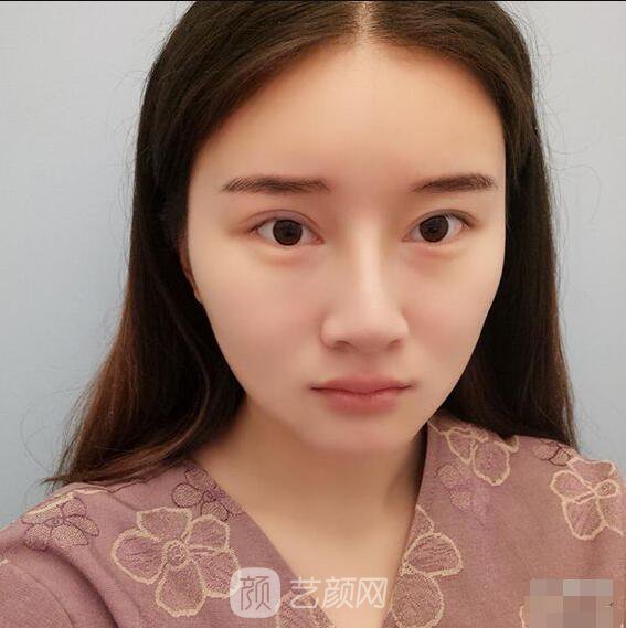 颧骨内推真实案例，小脸网红模板脸型