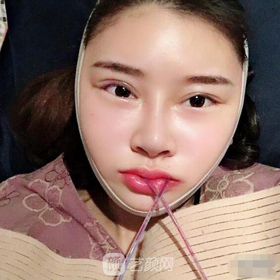 颧骨内推真实案例，小脸网红模板脸型