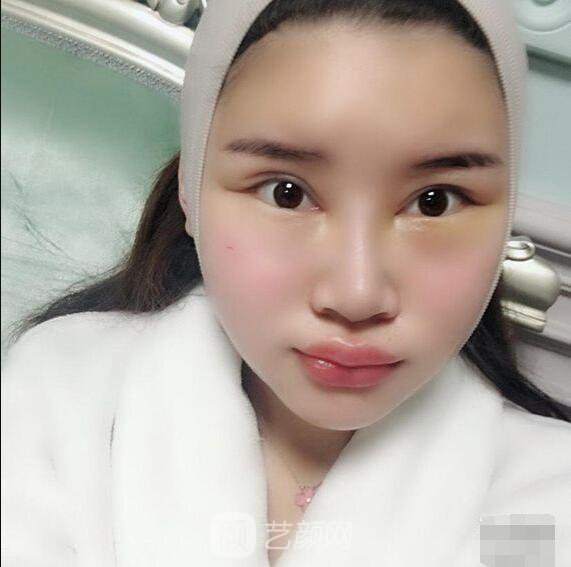 颧骨内推真实案例，小脸网红模板脸型