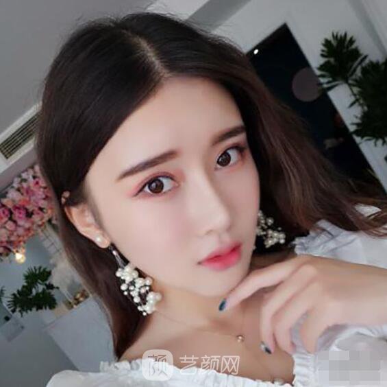 颧骨内推真实案例，小脸网红模板脸型