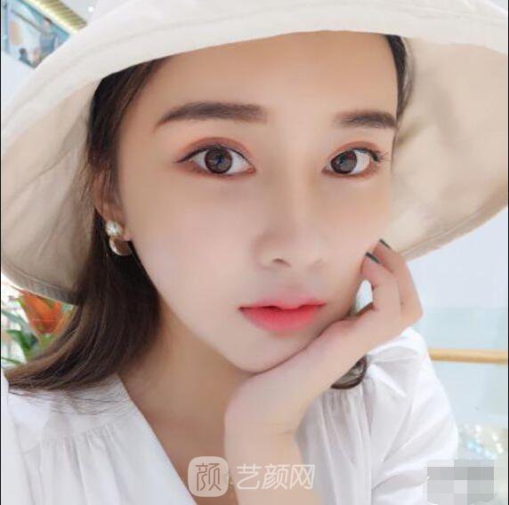 颧骨内推真实案例，小脸网红模板脸型