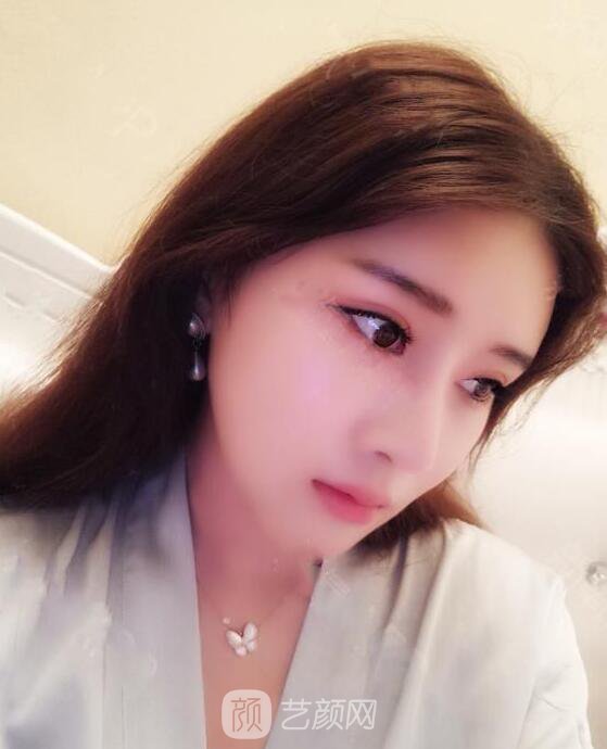 颧骨内推真实案例，小脸网红模板脸型