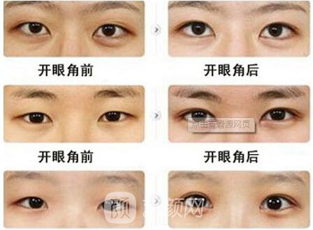 上海韩式开眼角多少钱?