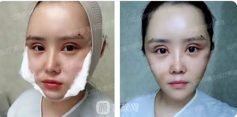 伊美尔幸福李辉灵动面部年轻化术后两个月恢复日记~