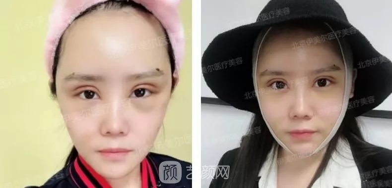 伊美尔幸福李辉灵动面部年轻化术后两个月恢复日记~