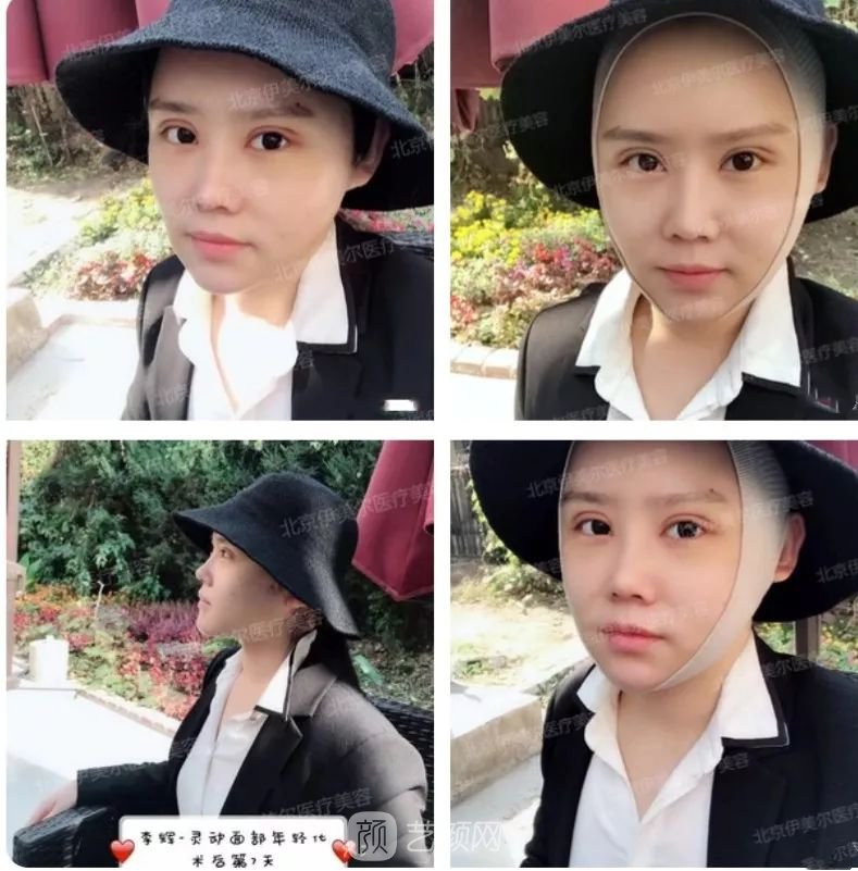 伊美尔幸福李辉灵动面部年轻化术后两个月恢复日记~