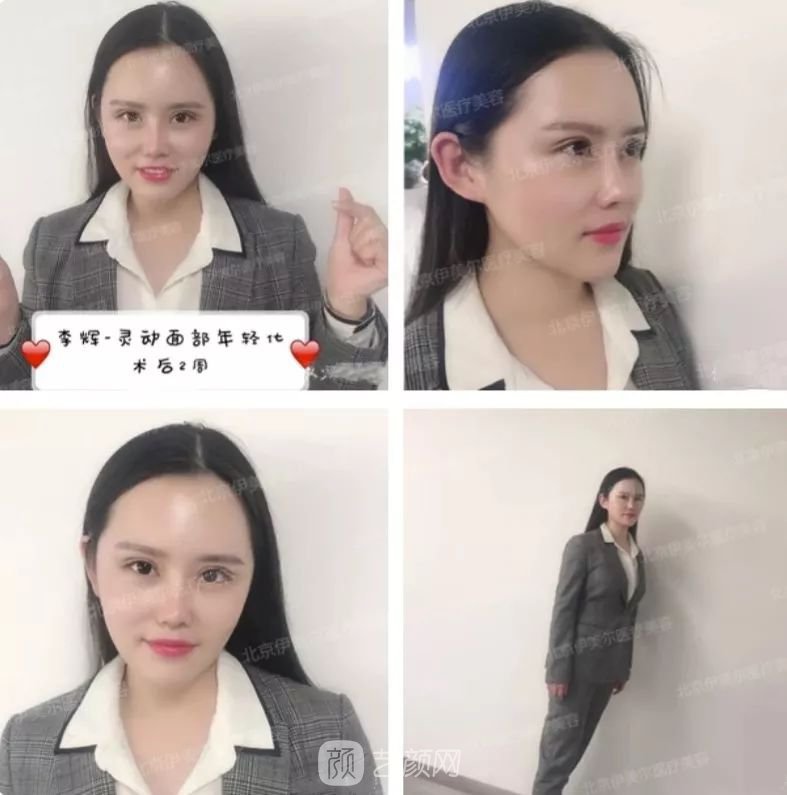 伊美尔幸福李辉灵动面部年轻化术后两个月恢复日记~