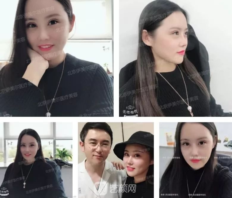 伊美尔幸福李辉灵动面部年轻化术后两个月恢复日记~