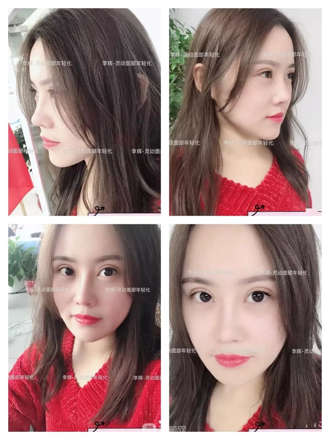 伊美尔幸福李辉灵动面部年轻化术后两个月恢复日记~