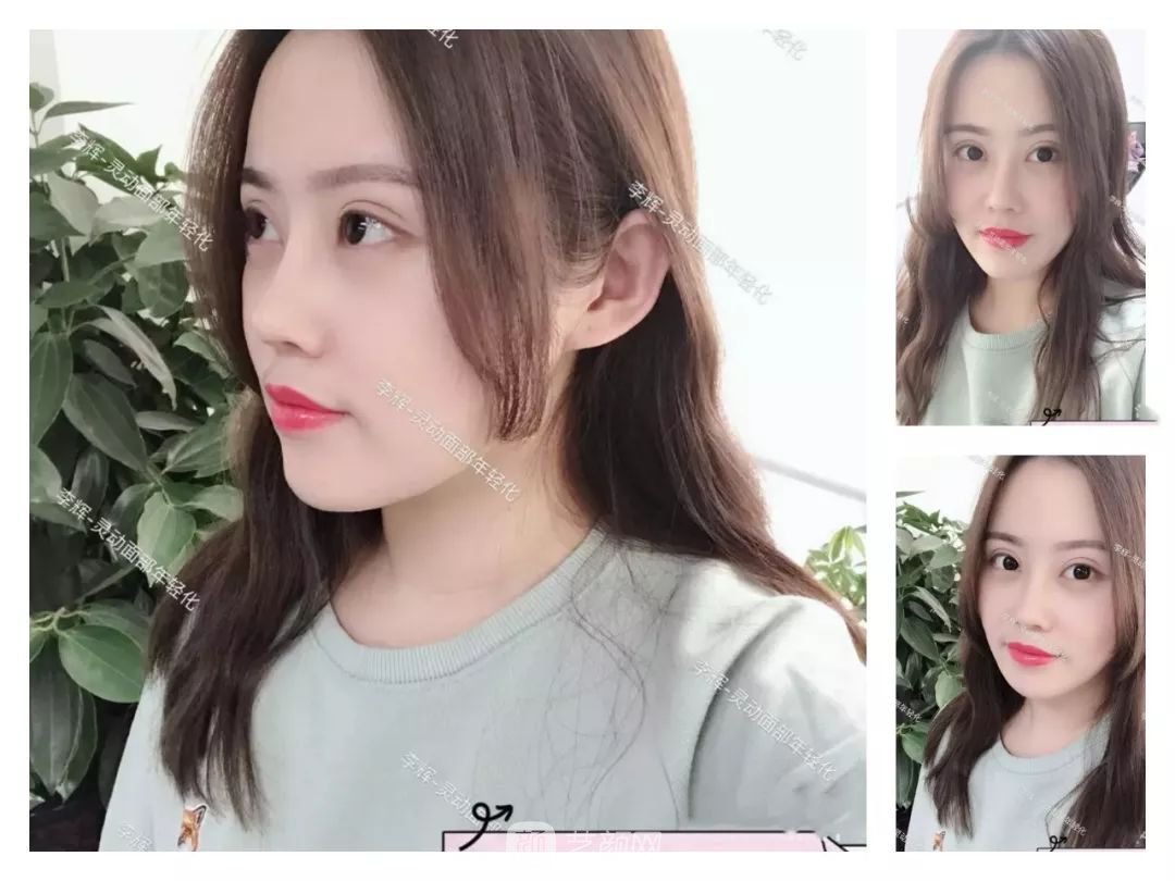 伊美尔幸福李辉灵动面部年轻化术后两个月恢复日记~