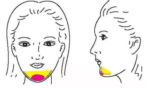 面部填充物取出要多少钱