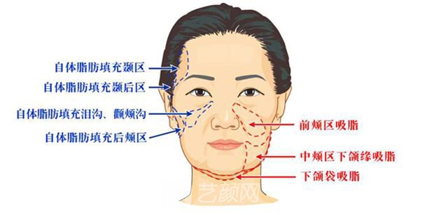 【拉皮手术果如何？拉皮手术果图~】