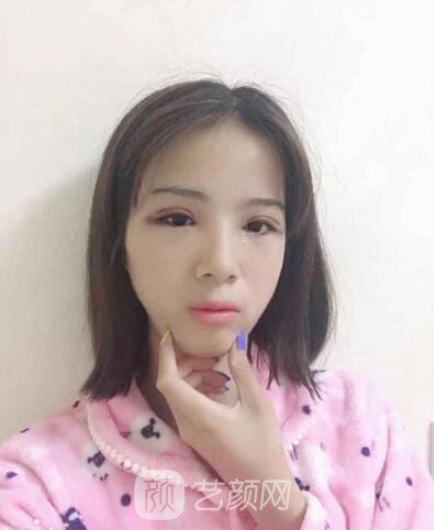 眼部手术真人案例