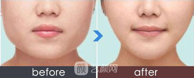 苏州注射瘦脸注射瘦脸多少钱?