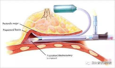 内窥镜假体隆胸多少钱?