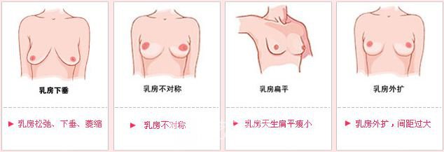 内窥镜假体隆胸多少钱?
