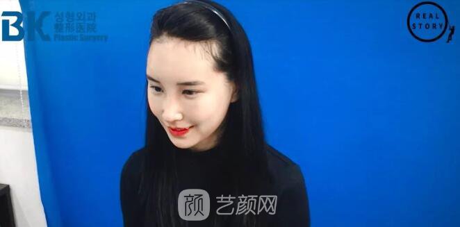 【新西兰美女整形日记】鼻部手术+面部脂肪移植——BK整形医院