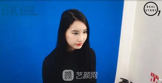 【新西兰美女整形日记】鼻部手术+面部脂肪移植——BK整形医院