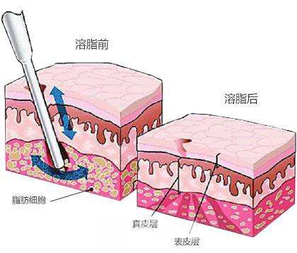 等离子光纤溶脂瘦脸果怎么样?