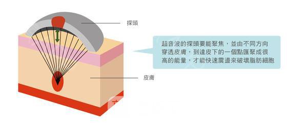 超声波吸脂价格?