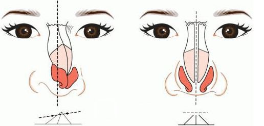 【假体隆鼻能维持多久？术后10年需每年检测一次价格几千到几万不等~】