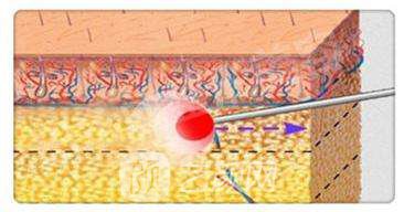 意大利plasma等离子激光光纤溶脂?