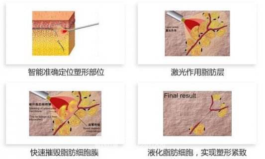 意大利plasma等离子激光光纤溶脂?