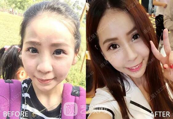 只需要5分钟，我的鼻子变高了！——南京艺星玻尿酸隆鼻~