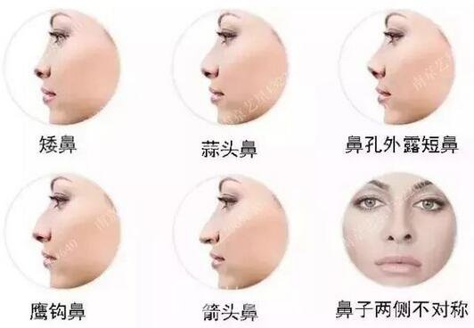 只需要5分钟，我的鼻子变高了！——南京艺星玻尿酸隆鼻~