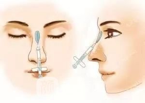 只需要5分钟，我的鼻子变高了！——南京艺星玻尿酸隆鼻~