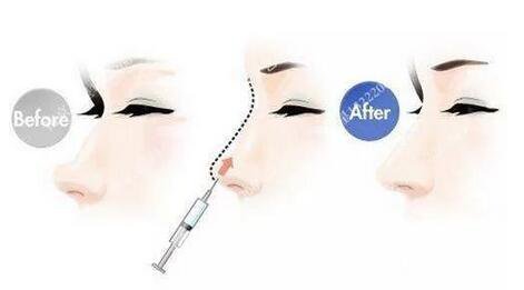 只需要5分钟，我的鼻子变高了！——南京艺星玻尿酸隆鼻~