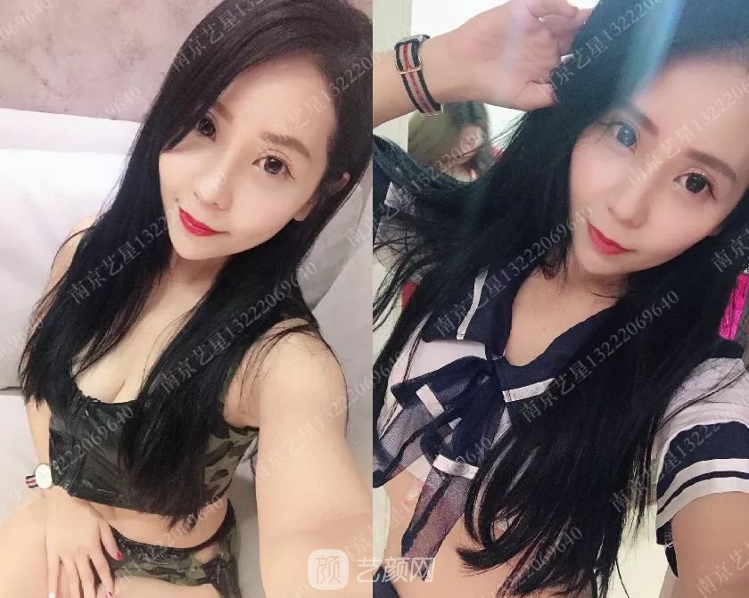 只需要5分钟，我的鼻子变高了！——南京艺星玻尿酸隆鼻~