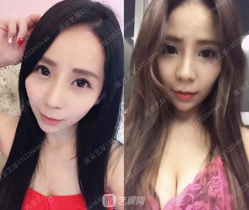 只需要5分钟，我的鼻子变高了！——南京艺星玻尿酸隆鼻~