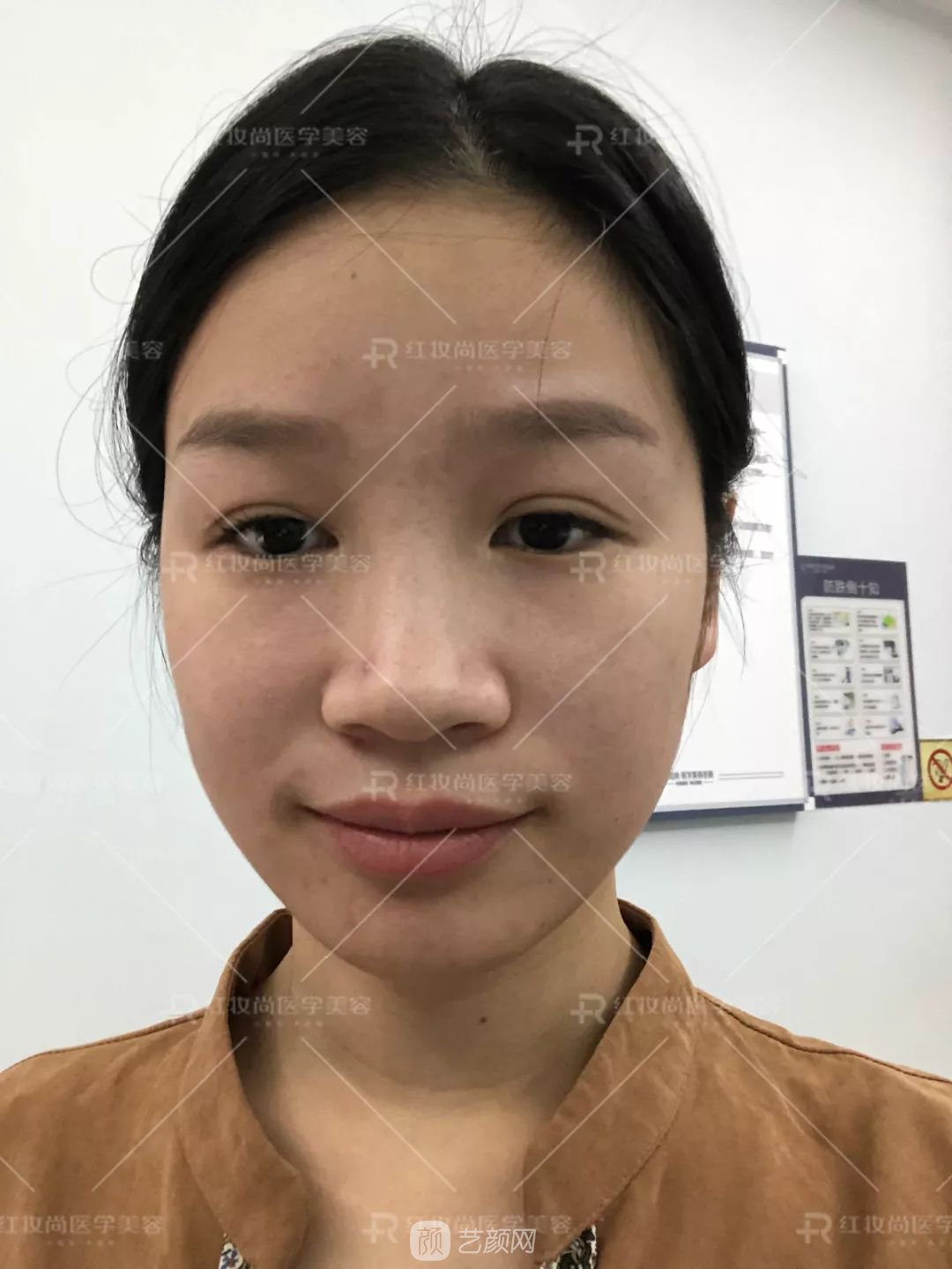 【蜕变日记】绝美侧颜的秘密——分享我的美鼻之旅~