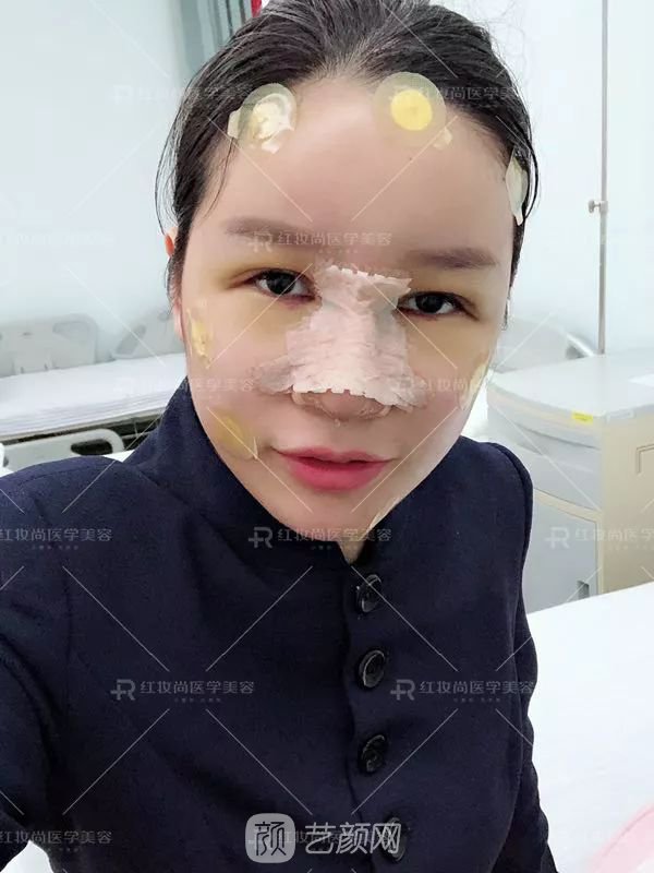 【蜕变日记】绝美侧颜的秘密——分享我的美鼻之旅~