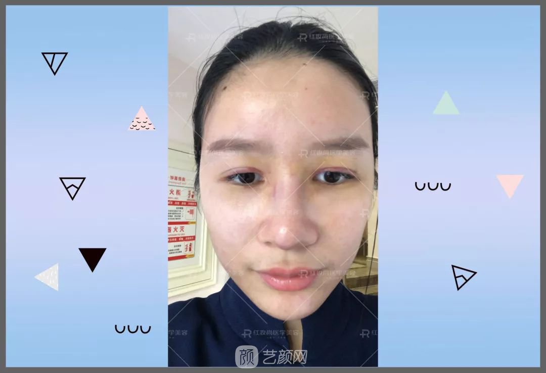 【蜕变日记】绝美侧颜的秘密——分享我的美鼻之旅~