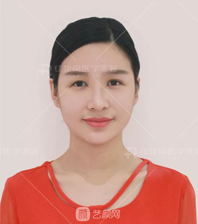 【蜕变日记】绝美侧颜的秘密——分享我的美鼻之旅~