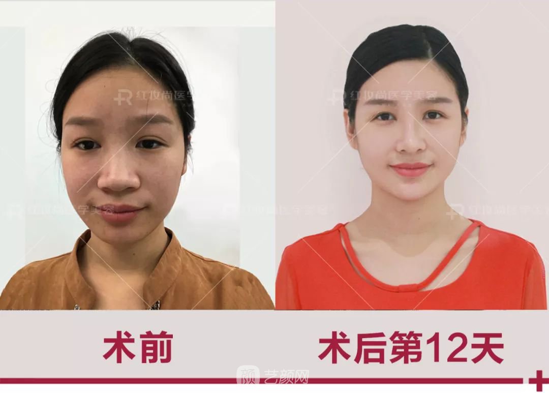 【蜕变日记】绝美侧颜的秘密——分享我的美鼻之旅~