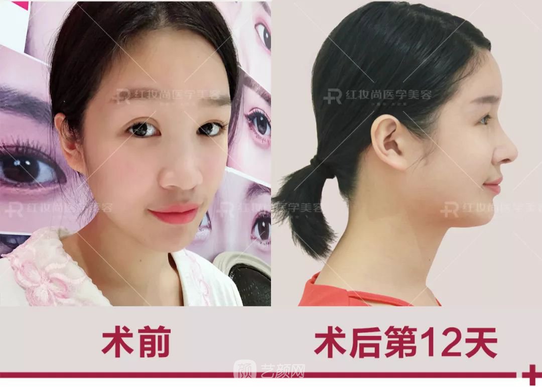 【蜕变日记】绝美侧颜的秘密——分享我的美鼻之旅~